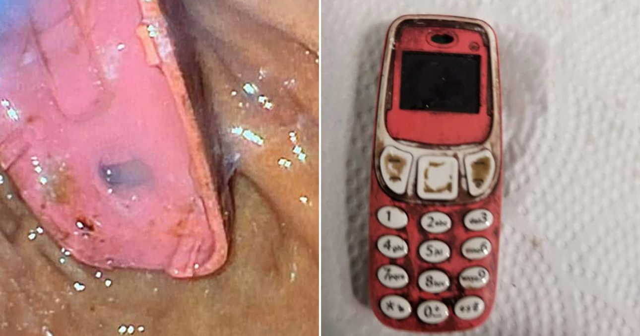 Tù nhân nuốt điện thoại Nokia 3310 vào bụng và cái kết - Nokia 3310 3